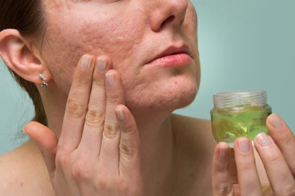 Girl applying aloe gel to problematic skin with acne scars
