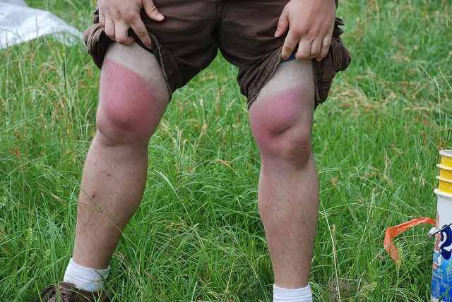 Extreme sunburn on legs